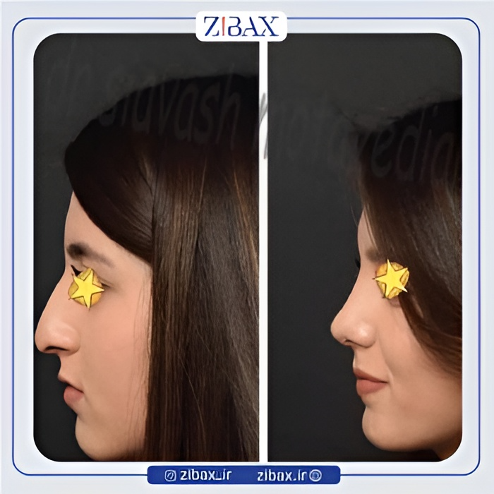 نمونه عمل جراحی بینی دکتر سیاوش معتضدیان — تصویر 7