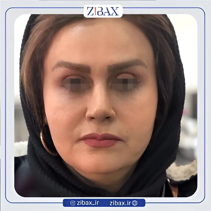نمونه عمل جراحی بینی دکتر میعاد موسوی — تصویر 2
