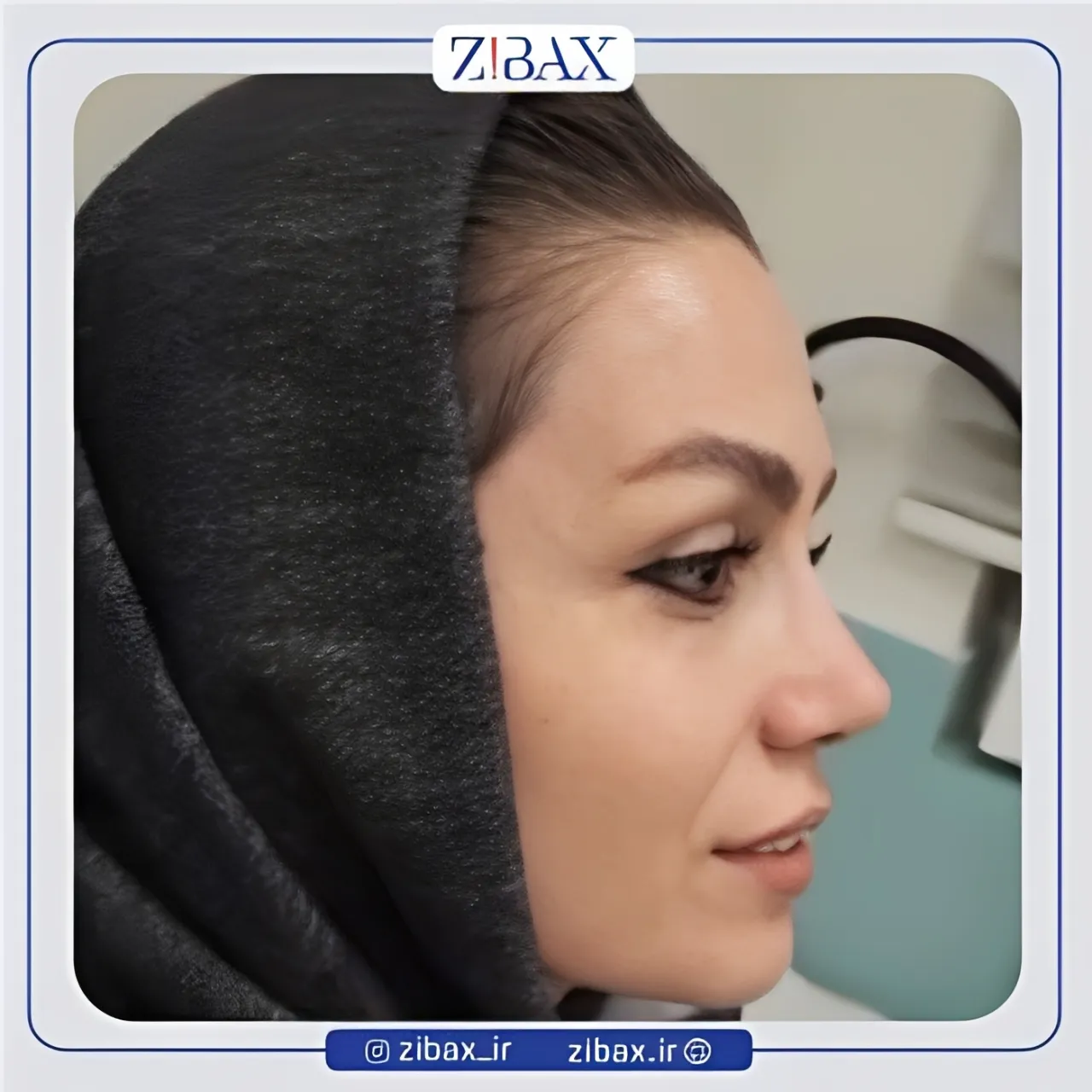 نمونه عمل جراحی بینی دکتر احمد علی رجب پور — تصویر 3