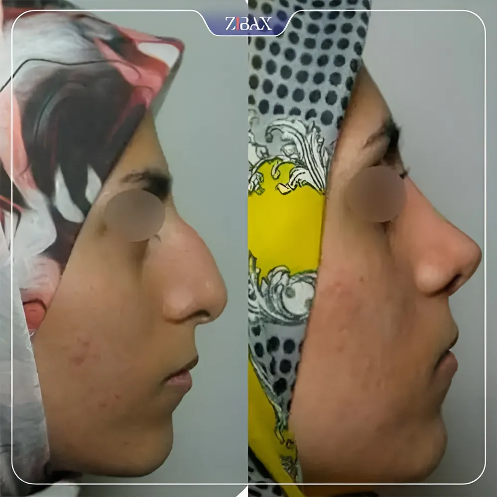 نمونه عمل جراحی بینی دکتر مسعود رادمان — تصویر 3