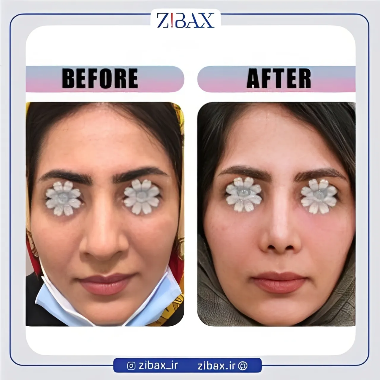 نمونه عمل جراحی بینی دکتر مینا جمالی — تصویر 7
