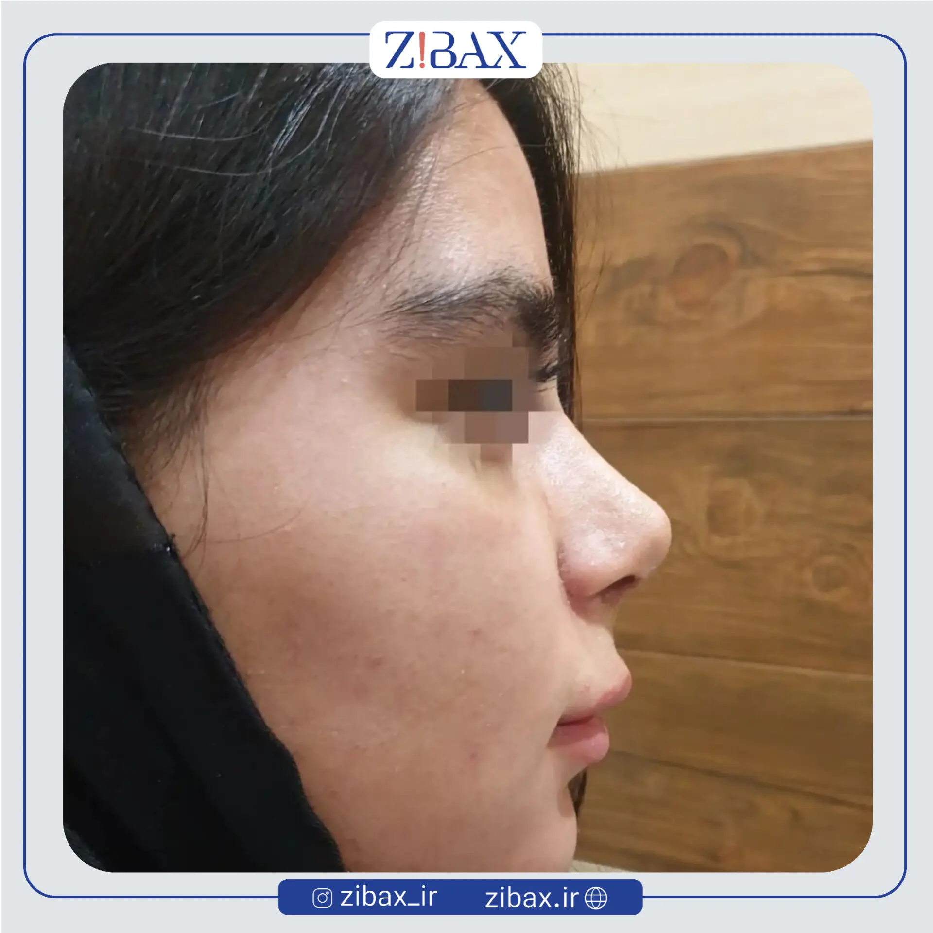 نمونه عمل جراحی بینی دکتر طیبه کاظمی — تصویر 7