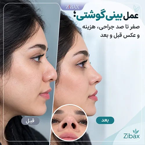 عمل بینی گوشتی