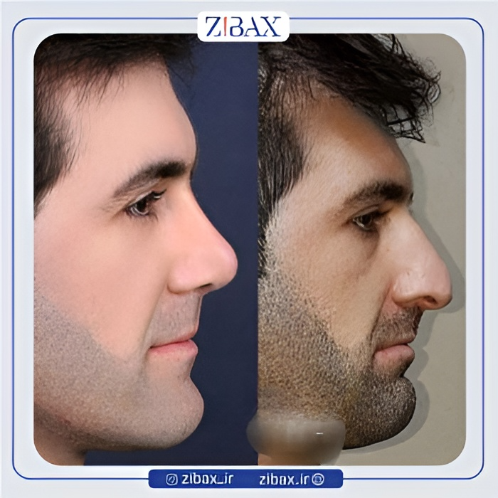 نمونه عمل جراحی بینی دکتر سعیدرضا توفیقی — تصویر 8