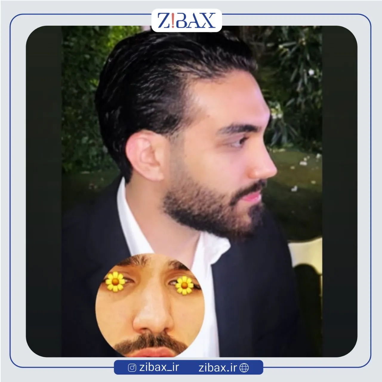 نمونه عمل جراحی بینی دکتر امین میراحمدی — تصویر 7
