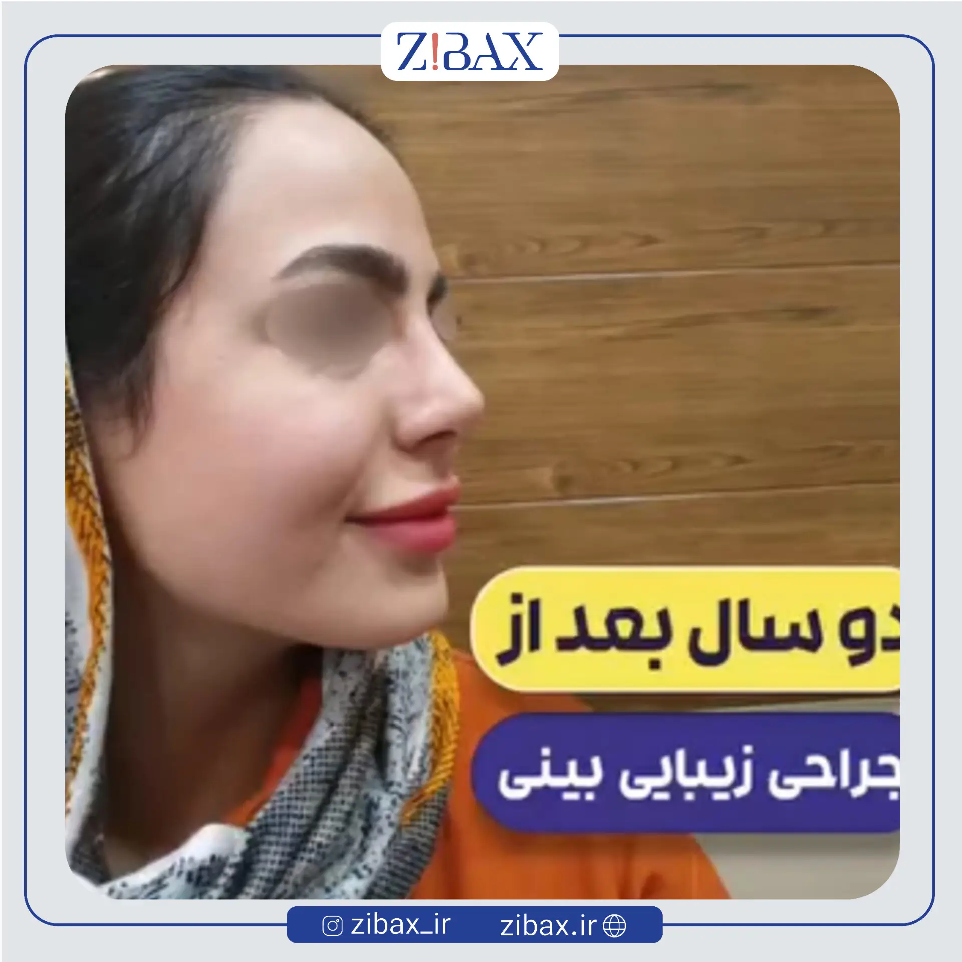 نمونه عمل جراحی بینی دکتر طیبه کاظمی — تصویر 2