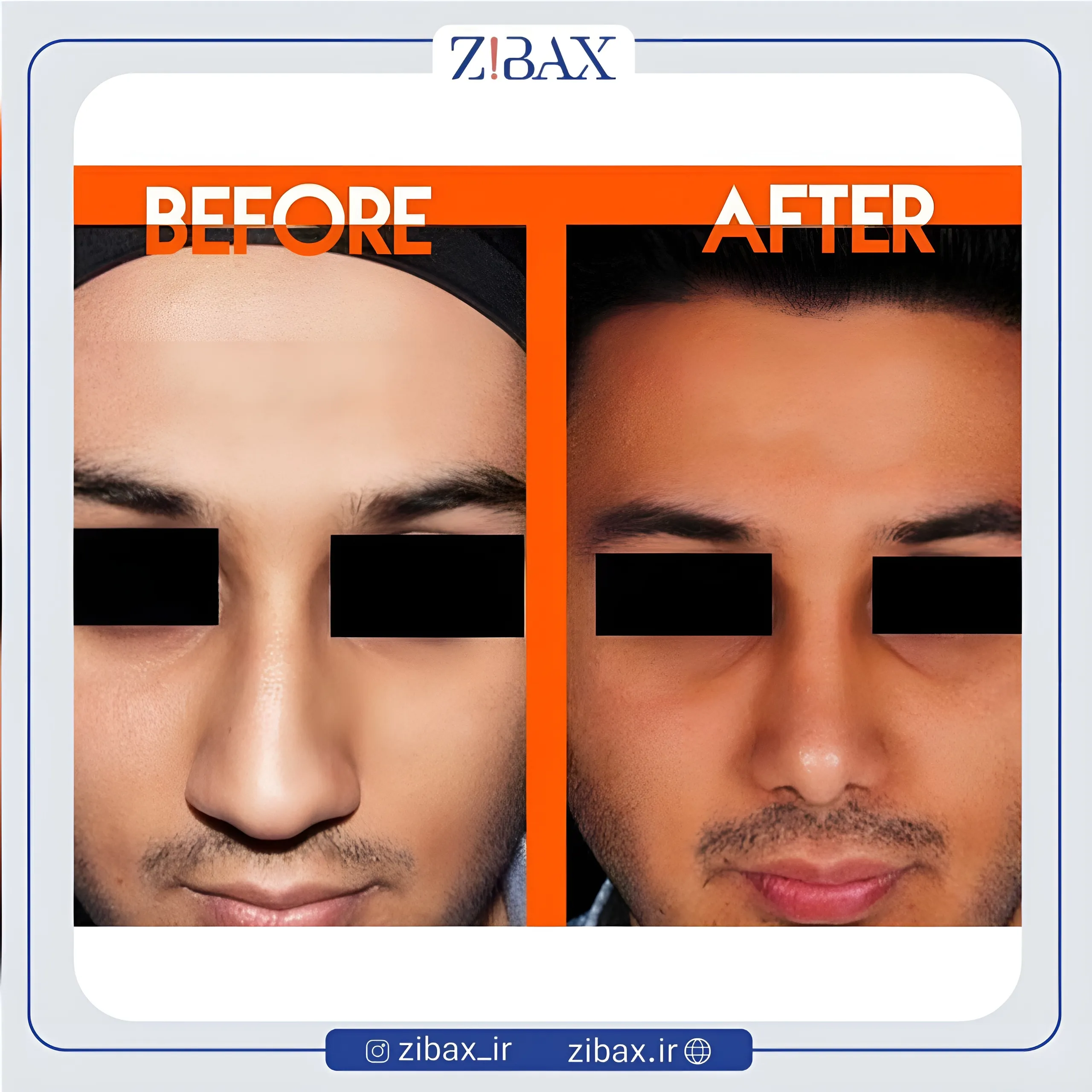 نمونه عمل جراحی بینی دکتر محمدرضا توکلی — تصویر 3