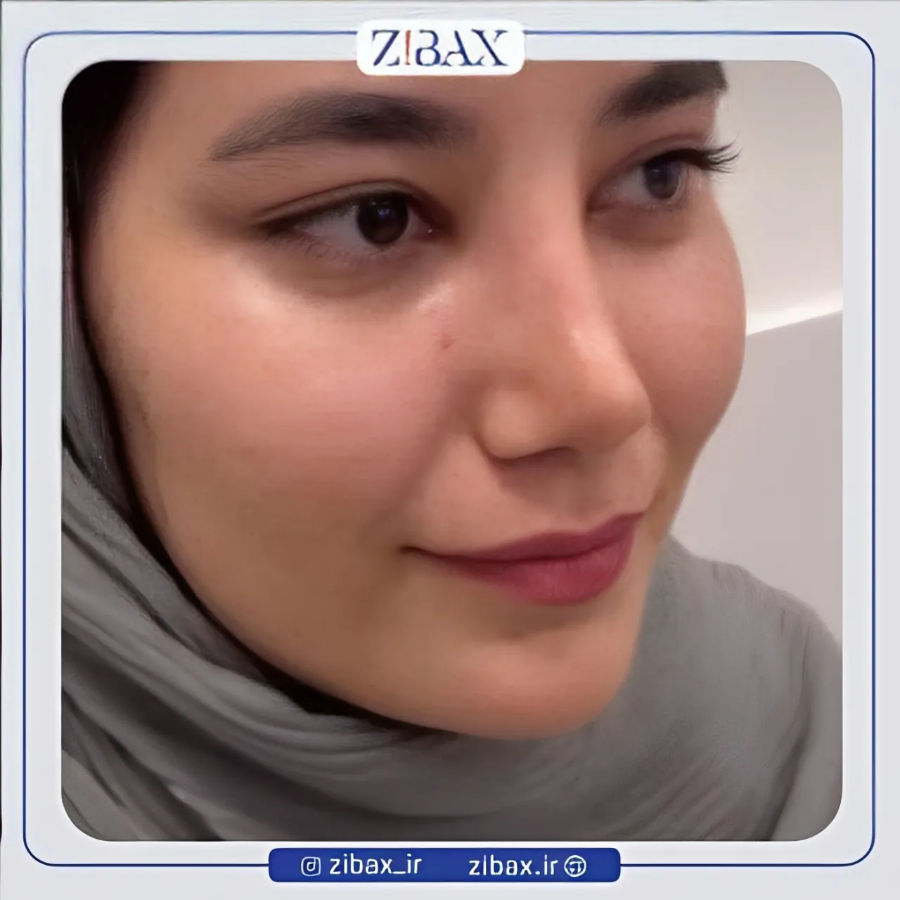 نمونه عمل جراحی بینی دکتر احمد علی رجب پور — تصویر 10