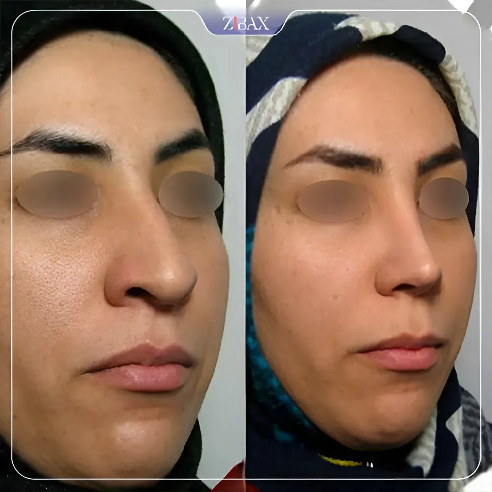 نمونه عمل جراحی بینی دکتر مسعود رادمان — تصویر 7