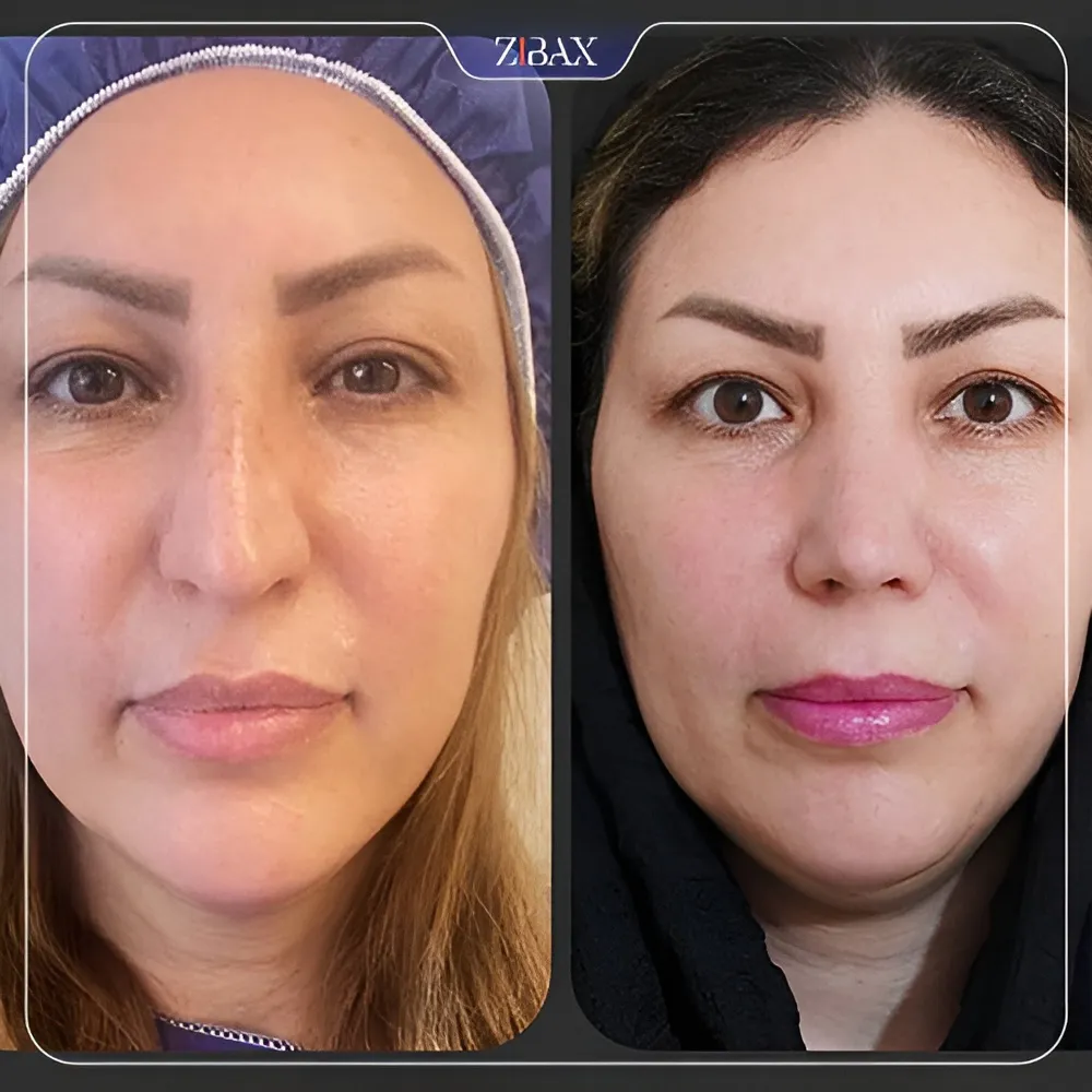 نمونه عمل جراحی بینی دکتر زهرا خسروی — تصویر 1