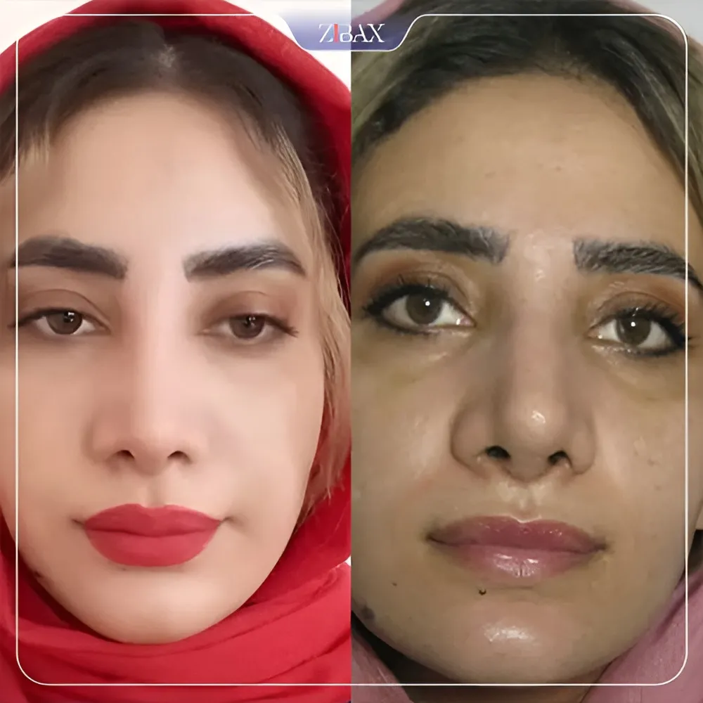 نمونه عمل جراحی بینی دکتر مسعود رادمان — تصویر 8
