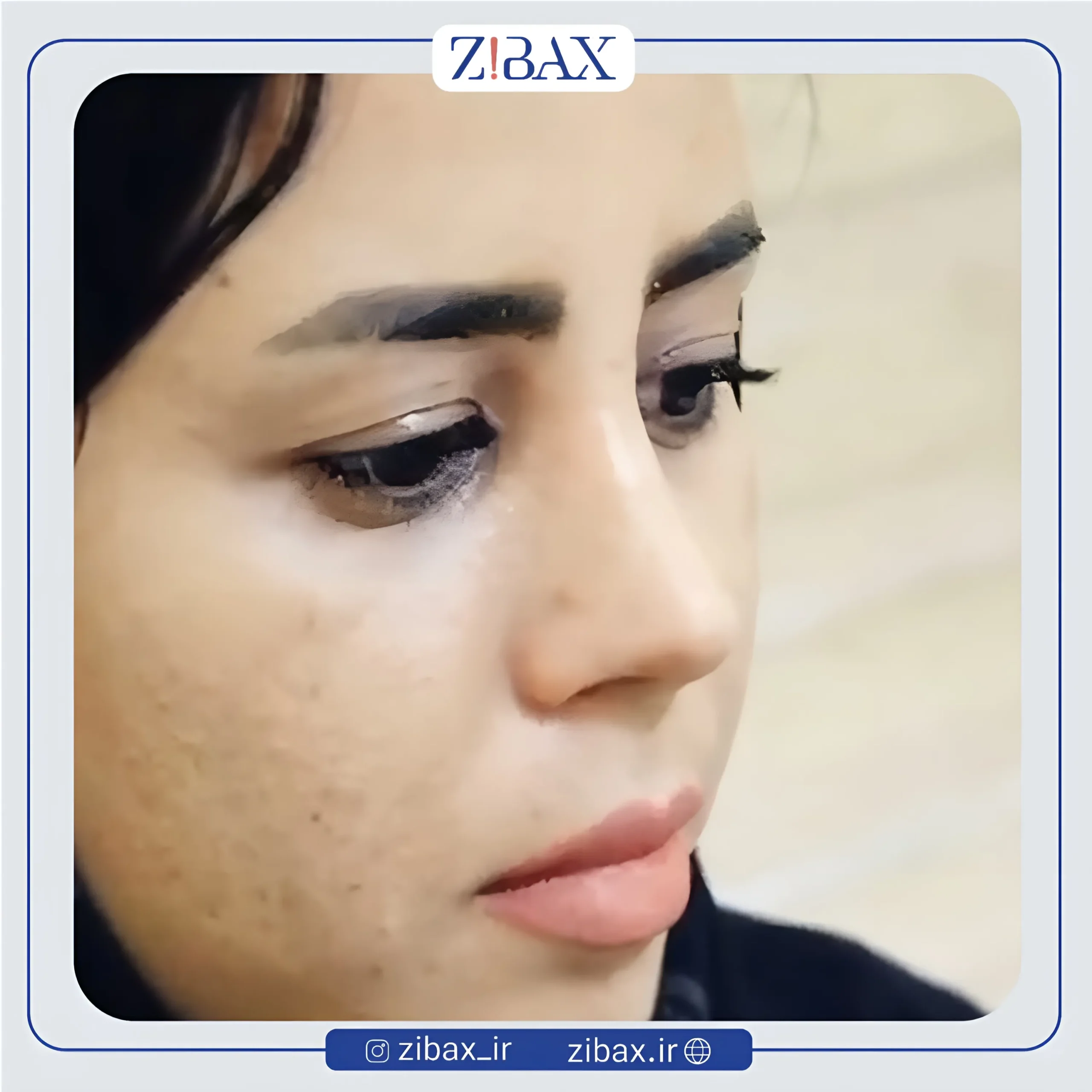 نمونه عمل جراحی بینی دکتر حمیدرضا راستی — تصویر 9