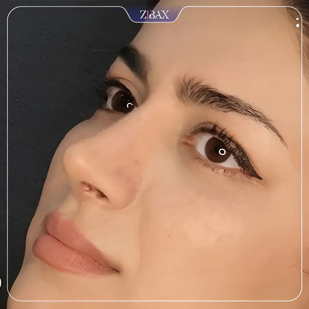 نمونه عمل جراحی بینی دکتر محمد باقر بخشی پور — تصویر 3