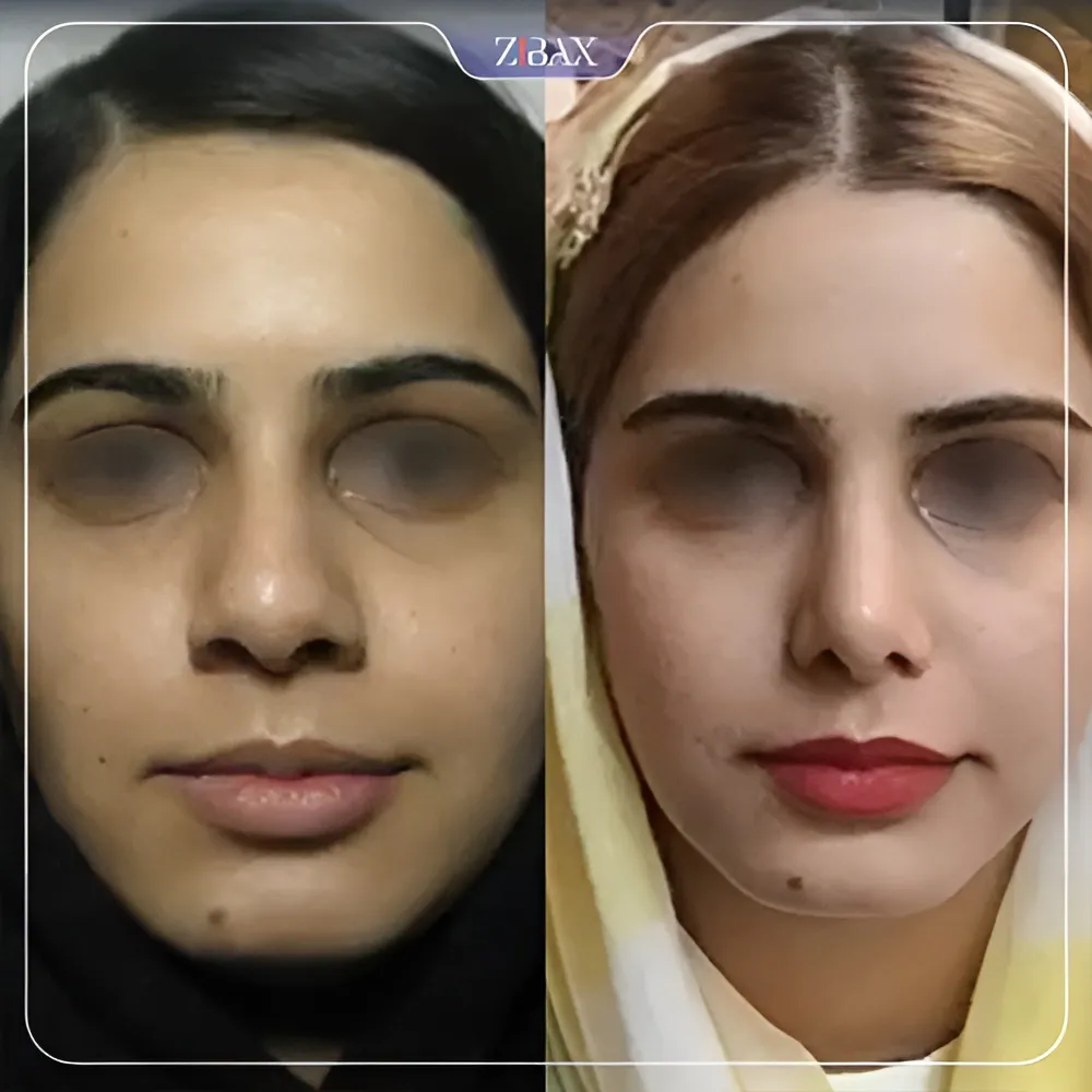 نمونه عمل جراحی بینی دکتر مسعود رادمان — تصویر 9