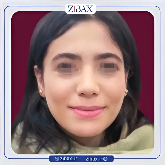نمونه عمل جراحی بینی دکتر میعاد موسوی — تصویر 6