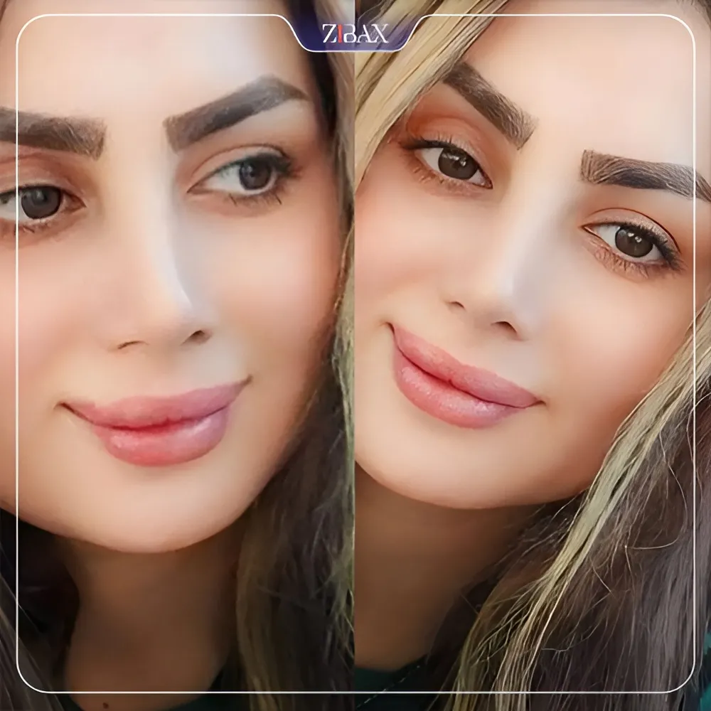 نمونه عمل جراحی بینی دکتر محمد باقر بخشی پور — تصویر 4