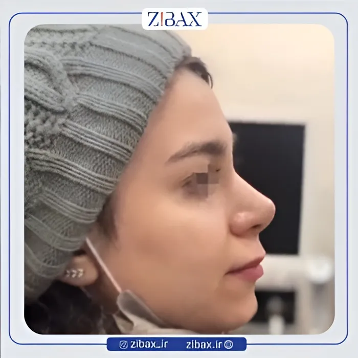 نمونه عمل جراحی بینی دکتر میعاد موسوی — تصویر 7