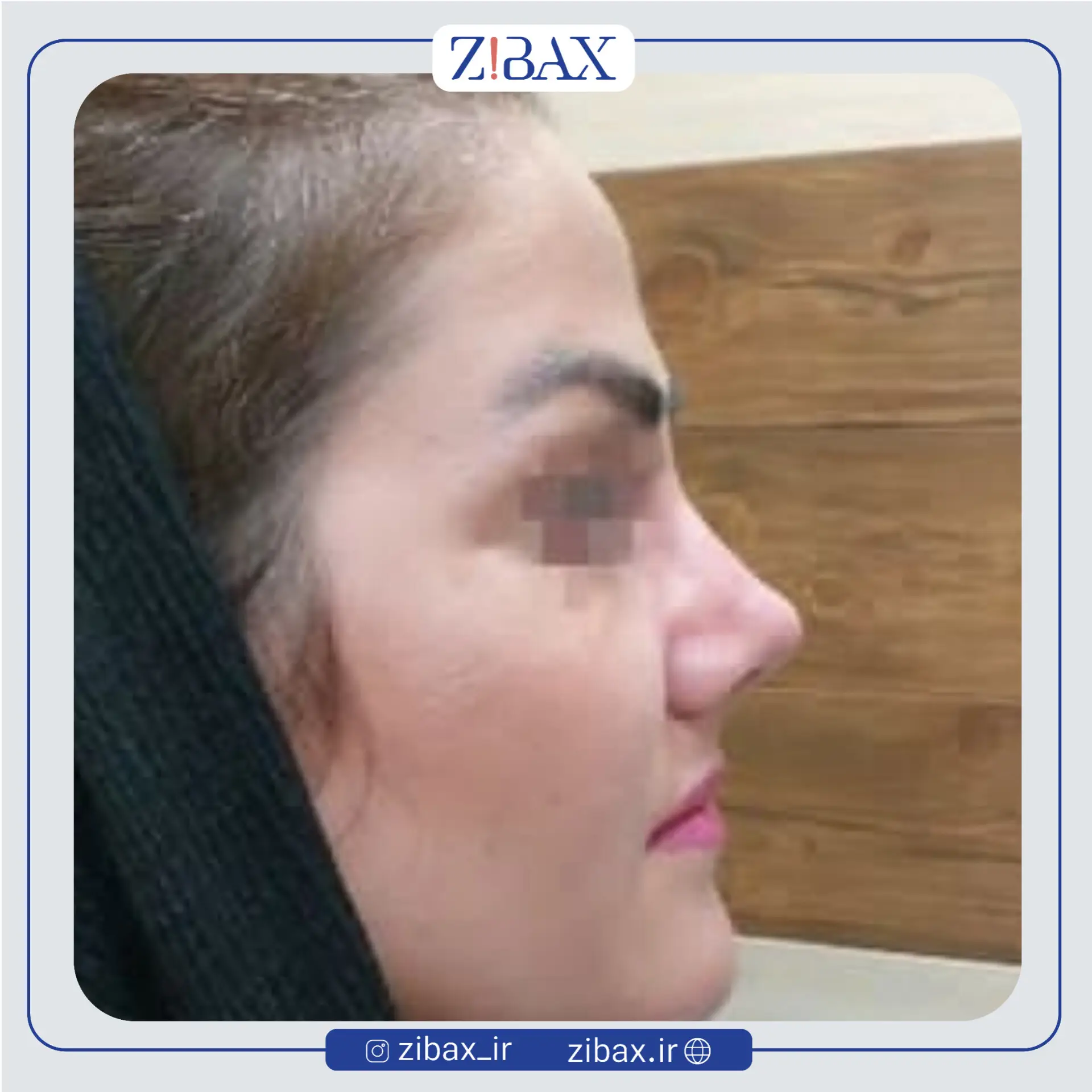 نمونه عمل جراحی بینی دکتر طیبه کاظمی — تصویر 3