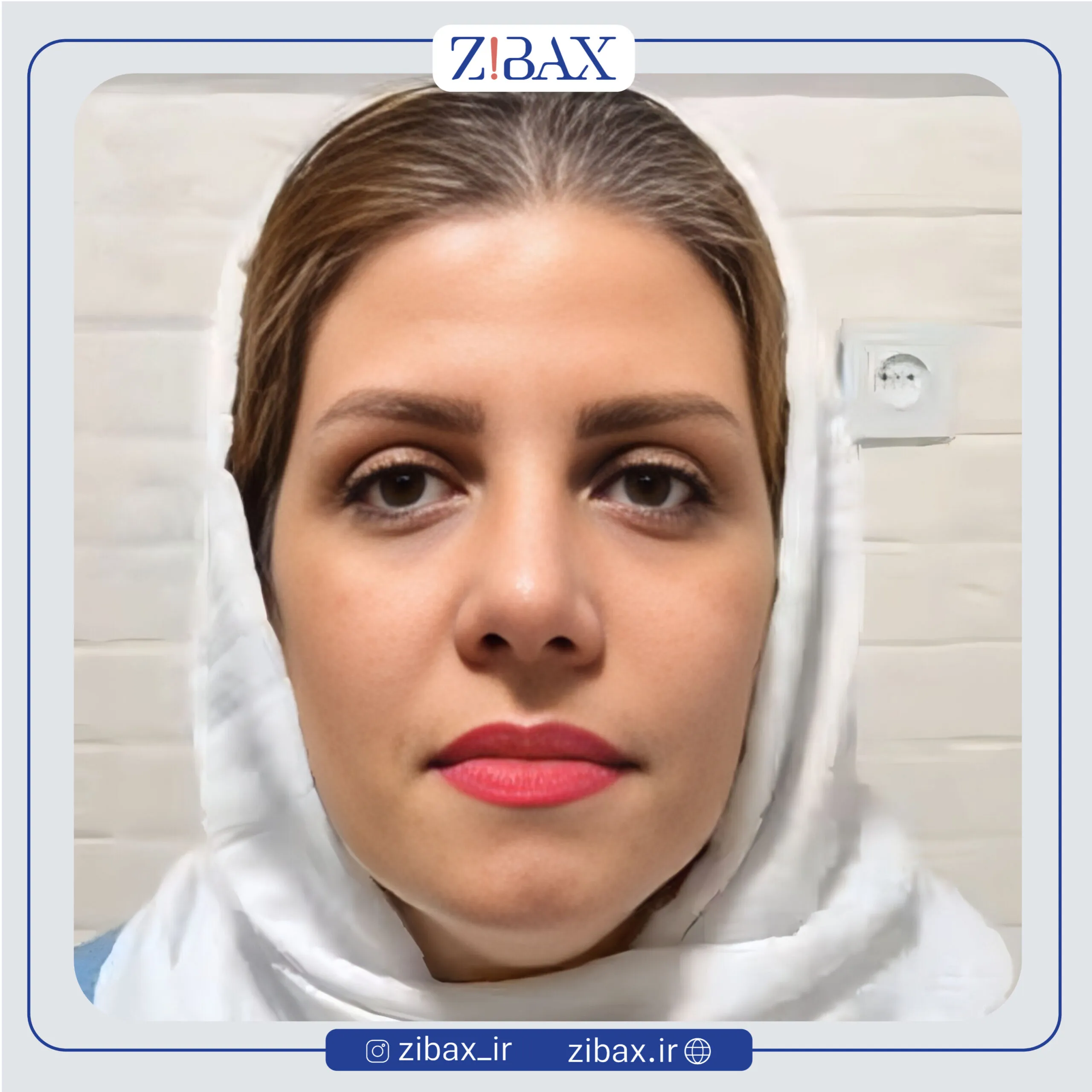 نمونه عمل جراحی بینی دکتر الهام کابلی — تصویر 10