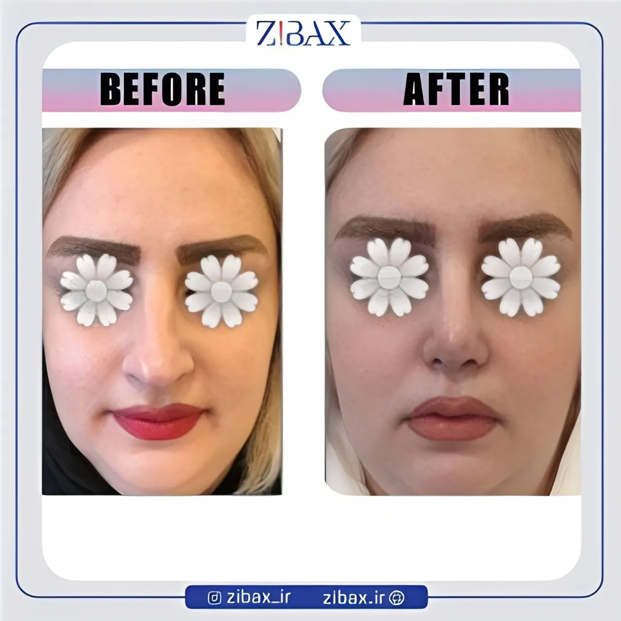 نمونه عمل جراحی بینی دکتر مینا جمالی — تصویر 10
