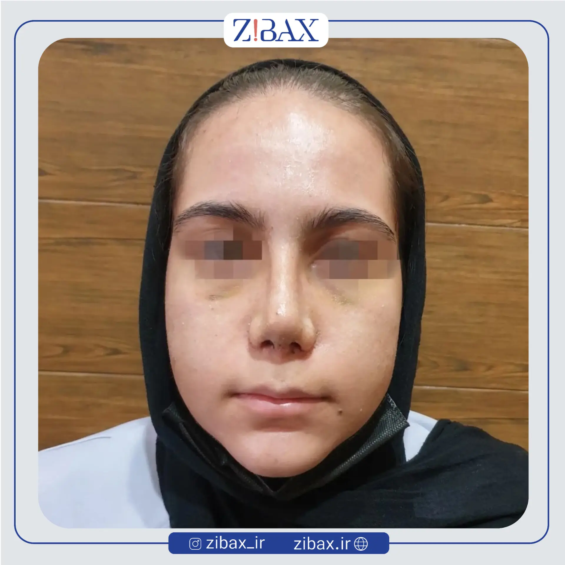 نمونه عمل جراحی بینی دکتر طیبه کاظمی — تصویر 4