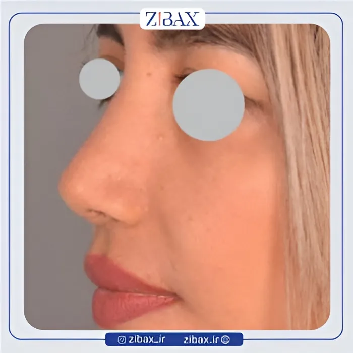 نمونه عمل جراحی بینی دکتر سیاوش معتضدیان — تصویر 2