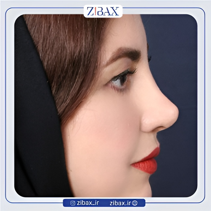 نمونه عمل جراحی بینی دکتر سعیدرضا توفیقی — تصویر 4