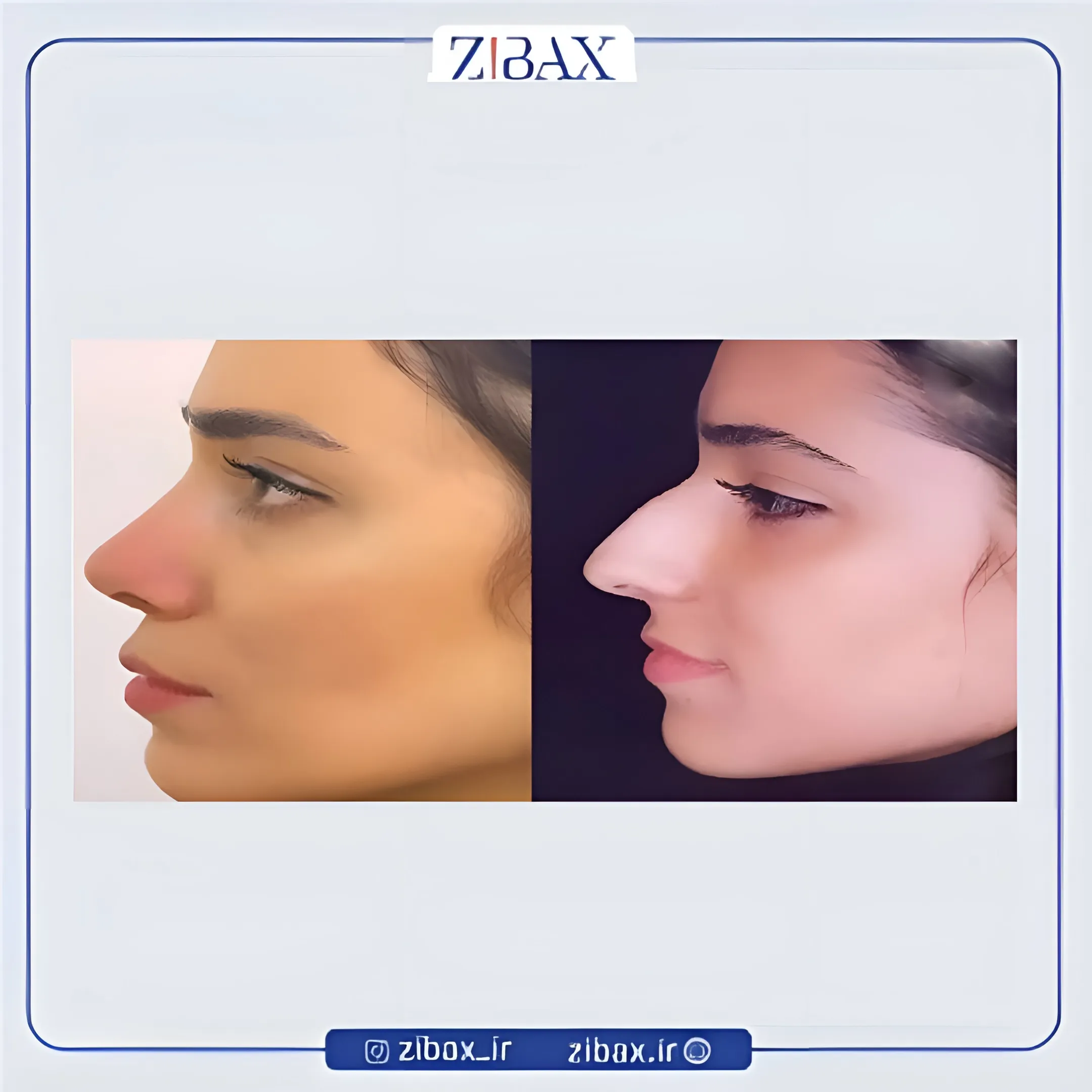 نمونه عمل جراحی بینی دکتر عبدالرسول صادقیان — تصویر 10