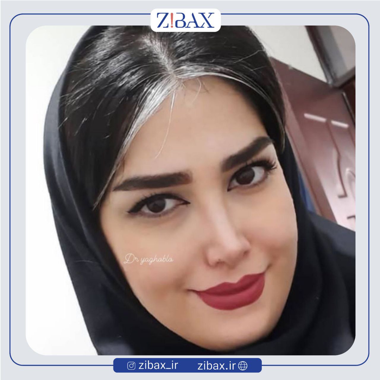 نمونه عمل جراحی بینی دکتر یوسف یعقوبلو — تصویر 2