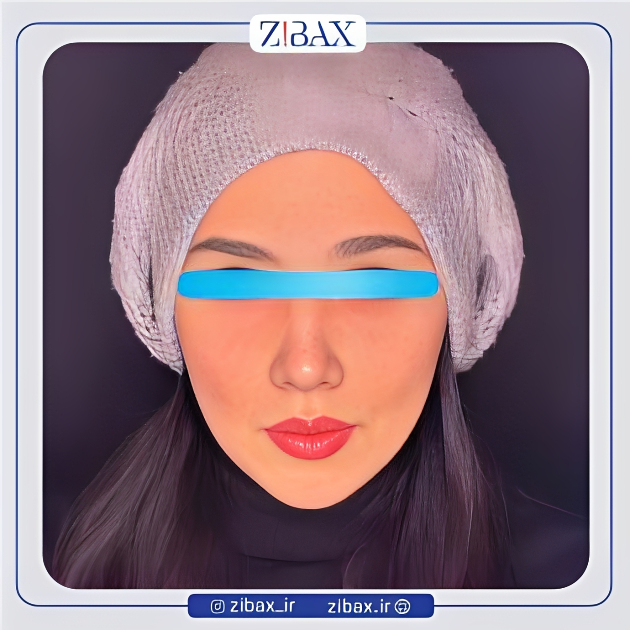 نمونه عمل جراحی بینی دکتر رضا چایچیان — تصویر 3