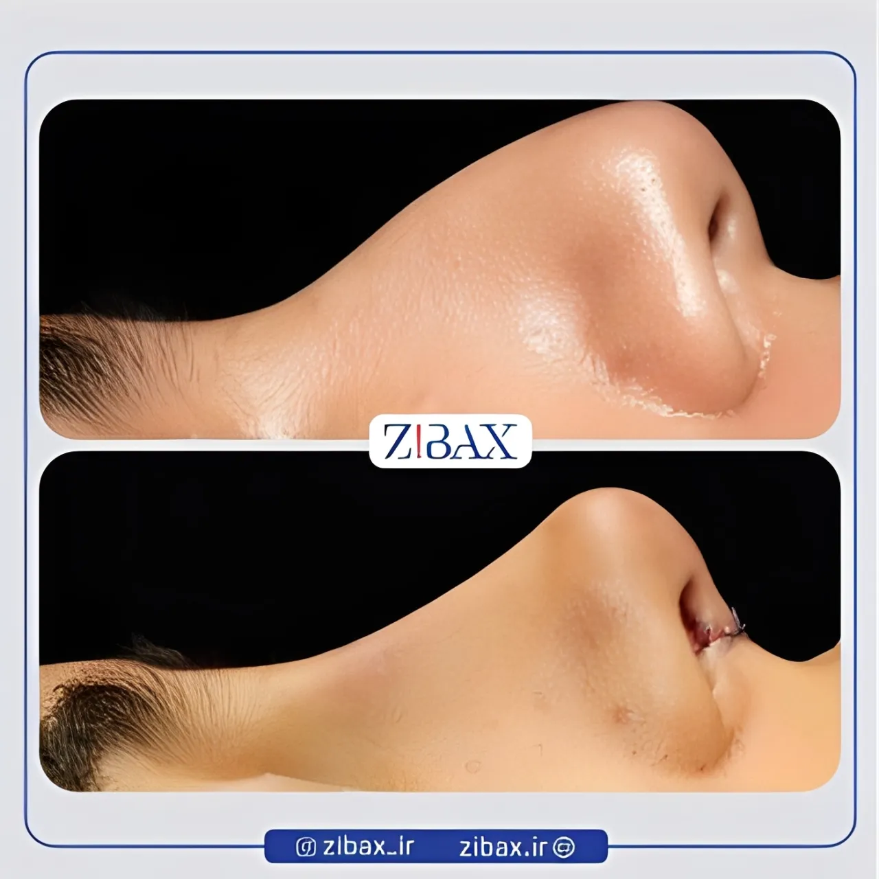 نمونه عمل جراحی بینی دکتر محمدباقر فتاحی — تصویر 1