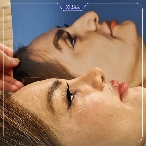 نمونه عمل جراحی بینی دکتر آزاده مرادی — تصویر 6