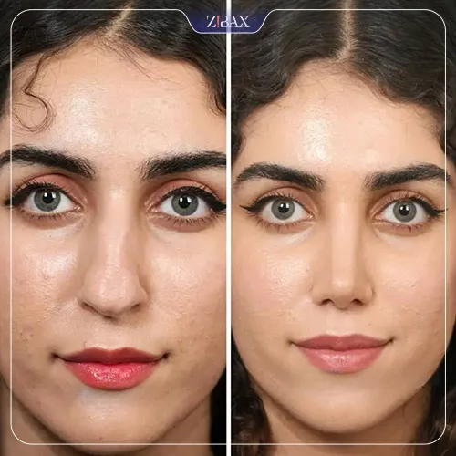 نتیجه جراحی