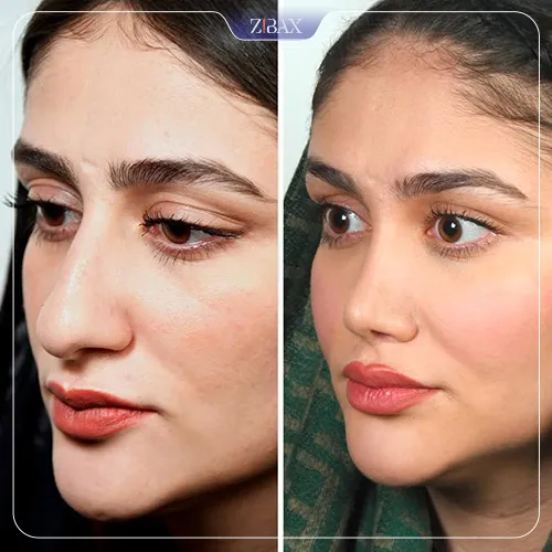 نتیجه جراحی