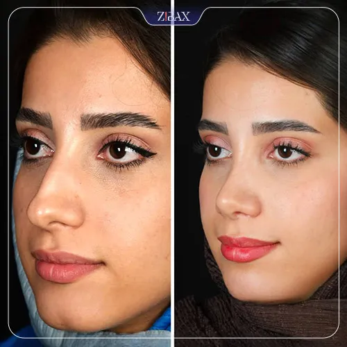 نتیجه جراحی
