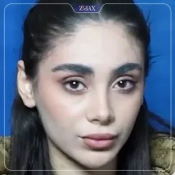 نمونه عمل جراحی بینی دکتر نسرین یزدانی — تصویر 3