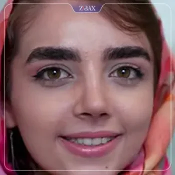 نمونه عمل جراحی بینی دکتر نسرین یزدانی — تصویر 7