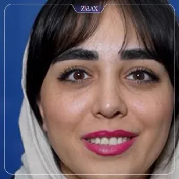 نمونه عمل جراحی بینی دکتر نسرین یزدانی — تصویر 4