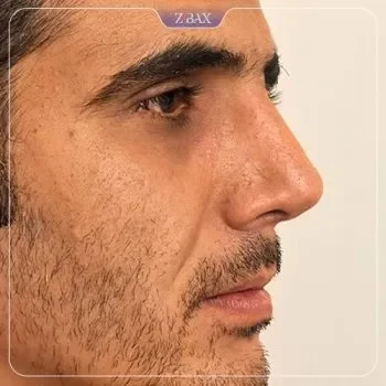 نمونه عمل جراحی بینی دکتر رضا سیدمحمد — تصویر 5