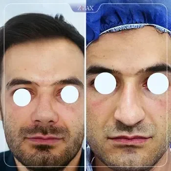 نمونه عمل جراحی بینی دکتر رضا سیدمحمد — تصویر 1