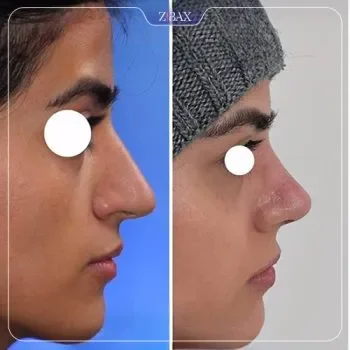 نمونه عمل جراحی بینی دکتر رضا سیدمحمد — تصویر 4