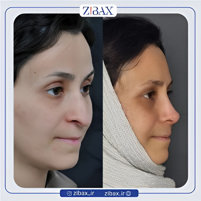 نمونه عمل جراحی بینی دکتر سعیدرضا توفیقی — تصویر 5