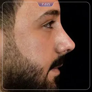 نمونه عمل جراحی بینی دکتر اردلان دهقانی — تصویر 1