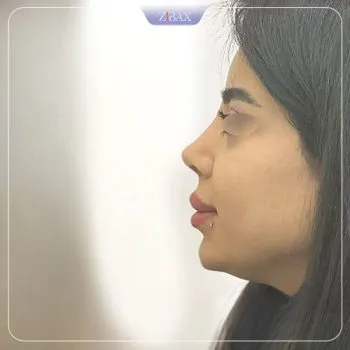 نمونه عمل جراحی بینی دکتر دنیا کرمی — تصویر 3