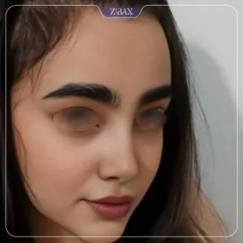 نمونه عمل جراحی بینی دکتر دنیا کرمی — تصویر 6