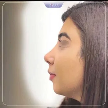 نمونه عمل جراحی بینی دکتر دنیا کرمی — تصویر 7