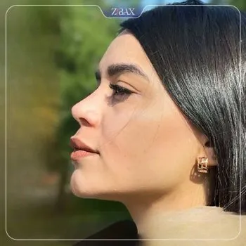 نمونه عمل جراحی بینی دکتر دنیا کرمی — تصویر 2