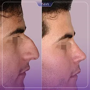 نمونه عمل جراحی بینی دکتر حاتم صالح پور — تصویر 9