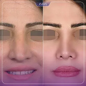 نمونه عمل جراحی بینی دکتر حاتم صالح پور — تصویر 2