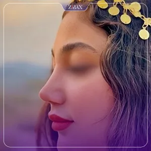 نمونه عمل جراحی بینی دکتر حاتم صالح پور — تصویر 3